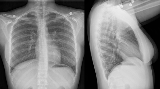 Normal AP and lateral two-view chest x-ray of a 16 year old female, full resolution digital radiograph