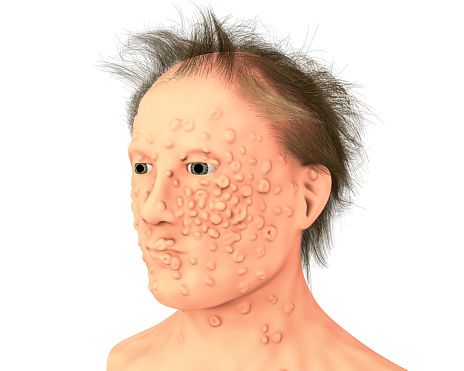 Un hombre con el virus de la infección y viruela la viruela, un virus de la familia Orthopoxviridae que causa la viruela photo