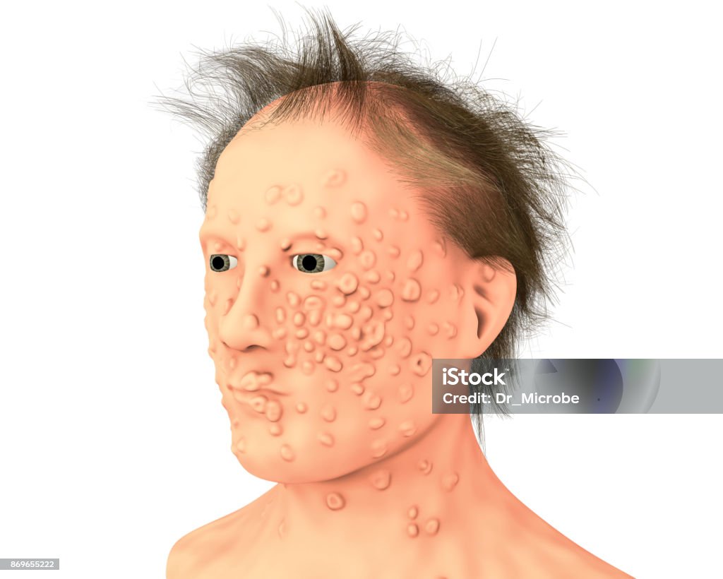 Un uomo con infezione da vaiolo e virus variola, un virus della famiglia Orthopoxviridae che causa il vaiolo - Foto stock royalty-free di Virus del vaiolo