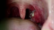 Residencia Patológico movimiento Angina Amigdalitis Purulenta Con Pus En Las Amígdalas De La Garganta Vídeo Stock y más Footage de Amigdalitis - iStock Residencia Patológico movimiento Angina Amigdalitis Purulenta Con Pus En Las Amígdalas De La Garganta Vídeo Stock y más Footage de Amigdalitis - iStock