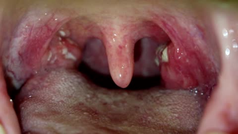 Residencia Patológico movimiento Angina Amigdalitis Purulenta Con Pus En Las Amígdalas De La Garganta Vídeo Stock y más Footage de Amigdalitis - iStock Residencia Patológico movimiento Angina Amigdalitis Purulenta Con Pus En Las Amígdalas De La Garganta Vídeo Stock y más Footage de Amigdalitis - iStock