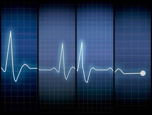 ECG Electrocardiogram