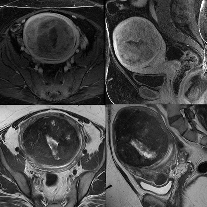 Clockwise, axial and sagittal T1 post contrast, then sagittal and axial T2 MRI of the pelvis with a large (11 cm) uterine fibroid with central necrosis, compressing the urinary bladder and rectum. Uterine fibroids are common benign tumors of the uterus that first appear during fertile years and grow with hormonal stimulation until menopause. They can be tiny and go unnoticed or grow as large as a full-term baby. In addition to expanding the waistline, fibroids can cause prolonged, heavy menstrual bleeding and pain, pelvic pain, and pressure on the bladder and rectum leading to difficulty with passing bowel movements and frequent urination. They can impair venous blood flow out of the legs, causing leg pain and heaviness. Most fibroids can be treated with a non-invasive procedure where the blood supply is cut off through a catheter threaded from the femoral artery into the uterine artery, termed uterine artery embolization or uterine fibroid embolization, performed by an interventional radiologist.