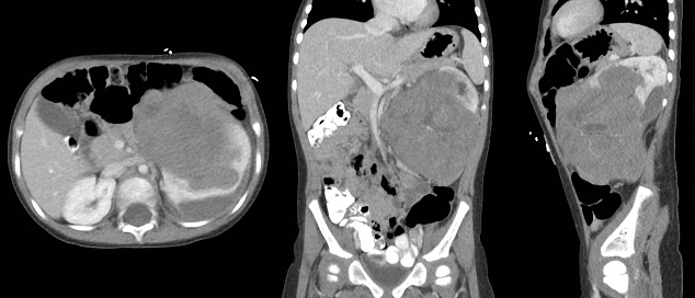 From left to right, axial, coronal and sagittal contrast-enhanced CT of the abdomen and pelvis of a young child demonstrating a large, aggressive abdominal tumor arising from the left kidney. This tumor and the attached kidney were removed and found to be a Wilms tumor. Named after Max Wilms, a German doctor who described the disease in 1899, Wilms tumor or nephroblastoma is the most common abdominal cancer and most common kidney cancer in children. It is often only diagnosed once it is large enough to feel or be seen pushing out of the abdomen. Fortunately, the vast majority of Wilms tumors are favorable histology and have a good chance of being cured with treatment. Treatment depends on the stage (size, location, spread) of tumor and begins with surgery to remove the tumor followed by chemotherapy, and often also radiation therapy.