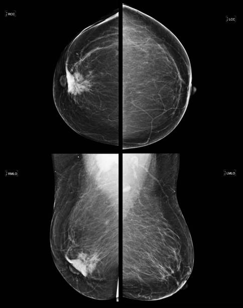 Screening Mammogram of Breast Cancer Full size digital screening mammogram of a new breast tumor in the retroareolar region of the right breast causing nipple retraction. An ultrasound guided biopsy was performed diagnosing invasive ductal carcinoma. This is the most common type of breast cancer, accounting for nearly 80% of cases. Breast cancer treatment has come a long way in the last few decades, seeing more funding than any other human disease. The first step to a cure is catching it early with screening mammograms such as this case so that the tumor can be removed before it spreads (metastasizes) out of the breast. cancer screening stock pictures, royalty-free photos & images