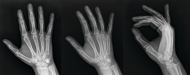 A series of 3 full size digital x-rays or radiographs of a normal hand. At the age of 18, the growth plates and ossification centers of the  hand have fully formed and fused. The bones are fully mature and finished growing.