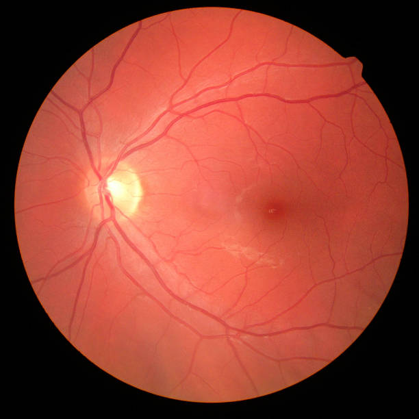 istock right eye's retinal image with macula, vessels and optic disc is 870084394