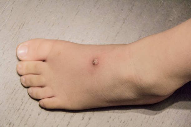 boy foot with wart stock photo