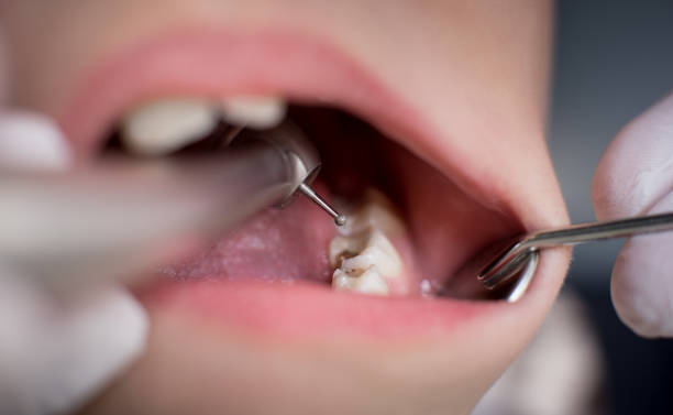 Open mouth during drilling treatment at the dentist in dental clinic. Close-up. Dentistry stock photo