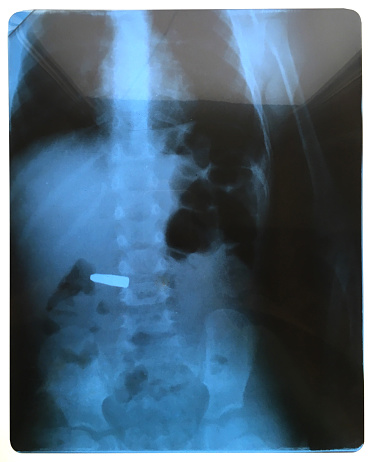 Xray Image Swallowed Object In Children Body Stock Photo - Download