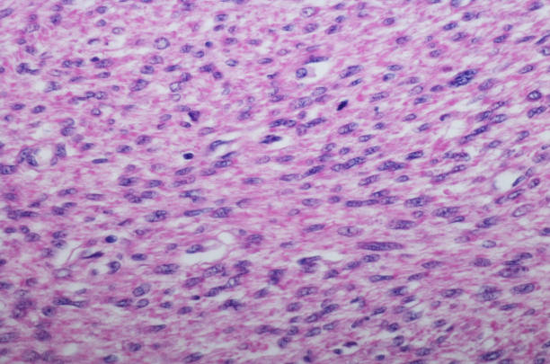istock Micrograph of Leiomyosarcoma (LMS) of the stomach 870807146