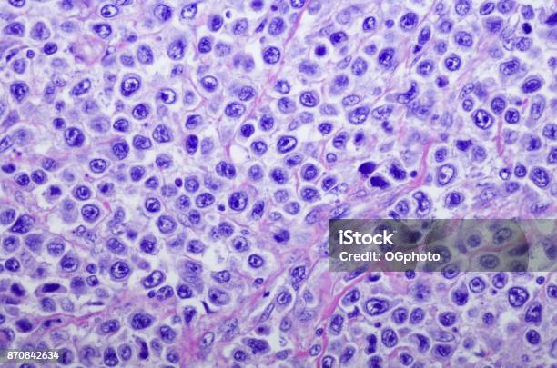 Diffuse Large Bcell Lymphoma Of Stomach Stock Photo - Download Image Now - Lymphoma, B-Cell, Biological Cell