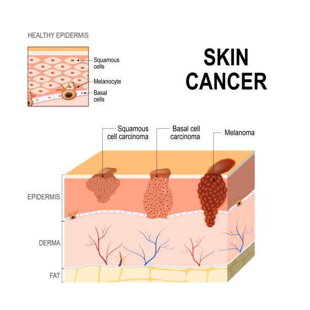Skin cancer. Squamous cell carcinoma, basal-cell cancer and Melanoma. Skin cancer: Squamous cell carcinoma (disease of older cells on the surface skin), basal-cell cancer (begins in the basal cells) and Melanoma (arises in the pigment cells - melanocytes). layers of human skin and healthy epidermis. Medical diagram melanoma stock illustrations