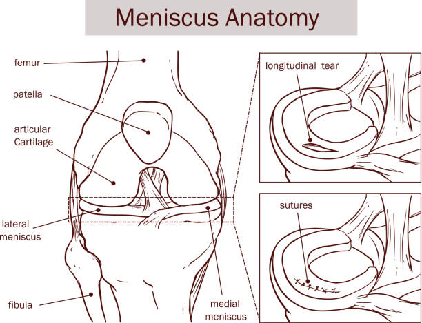 vektor-illustration eines meniskus riss und chirurgie - cruciate ligament stock-grafiken, -clipart, -cartoons und -symbole