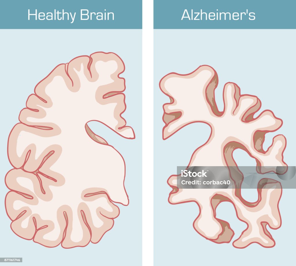 Alzheimer's Disease is a medical condition affecting the brain Alzheimer's Disease stock vector