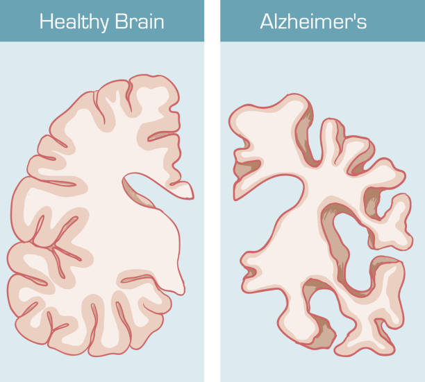 Alzheimer's Disease is a medical condition affecting the brain Alzheimer's Disease is a medical condition affecting the brain thalamus illustrations stock illustrations