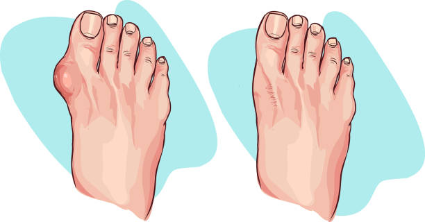 Vector illustration of bunion before and after operation vector art illustration