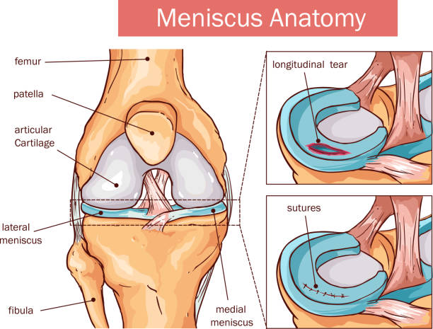 vektor-illustration eines meniskus riss und chirurgie - cruciate ligament stock-grafiken, -clipart, -cartoons und -symbole