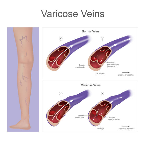 Vein pressure have become enlarged and twisted on the leg, result from damaged blood pressure valves. Illustration. Vein pressure have become enlarged and twisted on the leg, result from damaged blood pressure valves. Illustration. endothelial stock illustrations