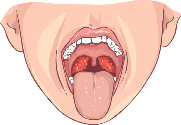 세균성 편도 선 염의 흰색 배경 벡터 일러스트 레이 션 - pharyngitis stock illustrations