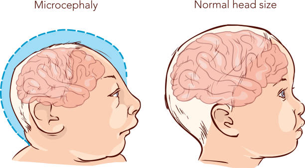 Illustration of a newborn baby with Microcephaly disease caused by Zika virus Illustration of a newborn baby with Microcephaly disease caused by Zika virus microcephaly baby stock illustrations