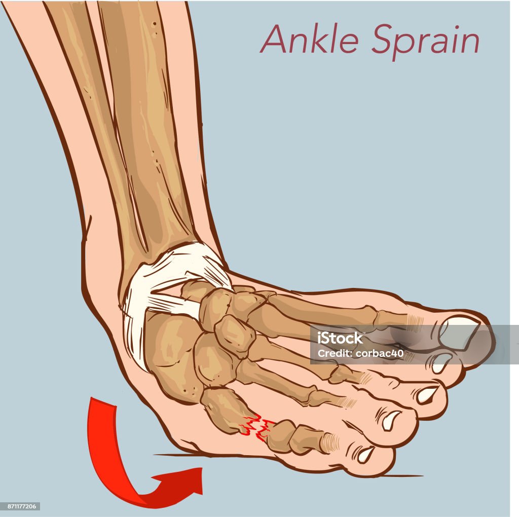 Ankle Sprain While Walking Illustration About Medical And Good Foot Care  Stock Illustration - Download Image Now - iStock