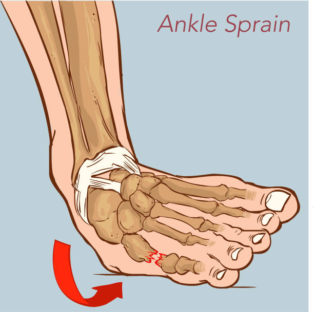Ankle sprain while walking. Illustration about medical and good foot care. vector art illustration