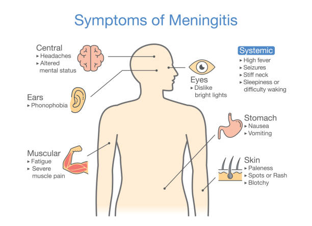 ilustrações, clipart, desenhos animados e ícones de diagrama mostrando sintomas de paciente com doença de meningite. - meningite