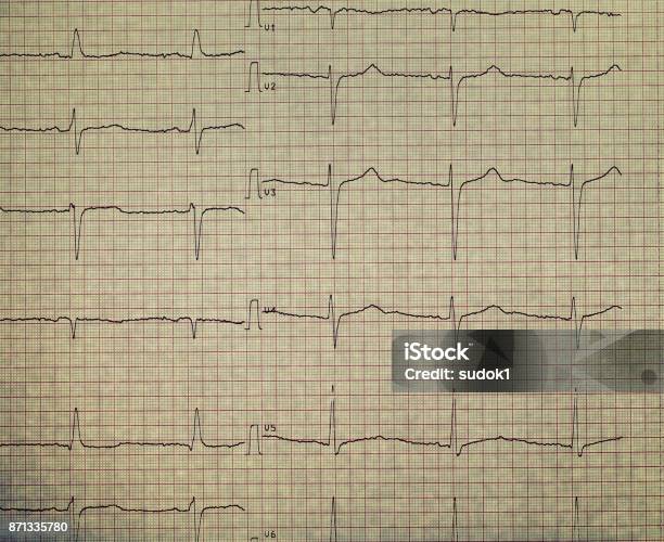 Ecg Paper Pattern Ecg On The Plotting Paper Stock Photo - Download Image Now - Abstract ...