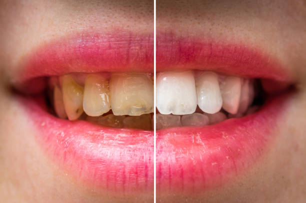 istock Woman teeth before and after dental treatment 871478792