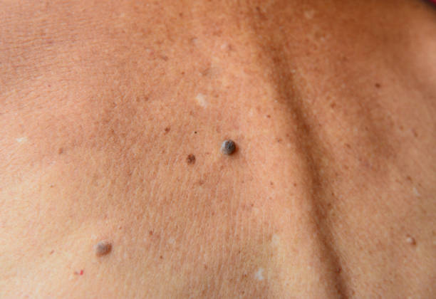 istock Mole on old woman skin 871524256