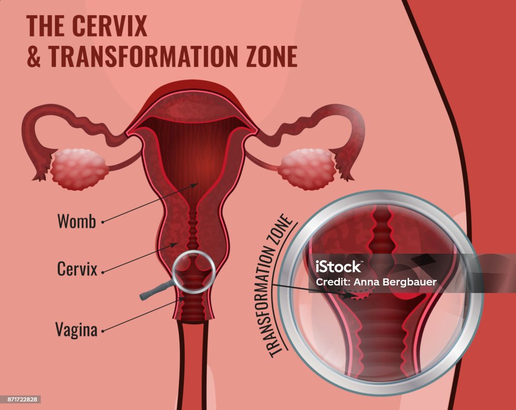 Cervical screening image The cervix and transformation zone. Medical infographic. Female reproductive system - uterus, ovary glands and fallopian tubes. Scientific vector illustration in red and pink colors. Cervix stock vector