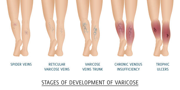 309 Varicose Veins Illustrations & Clip Art - iStock | Varicose veins  treatment, Varicose veins active, Spider veins