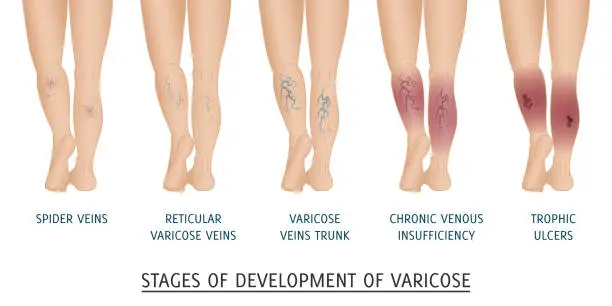 Vector illustration of Types of varicose veins in women. Stages of development of varic