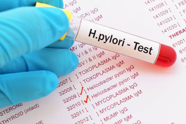 Helicobacter pylori test stock photo