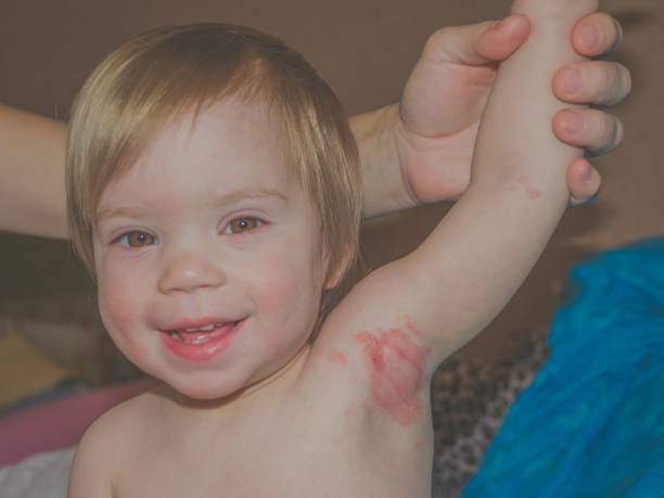 istock Allergy in children in the axilla 872432920