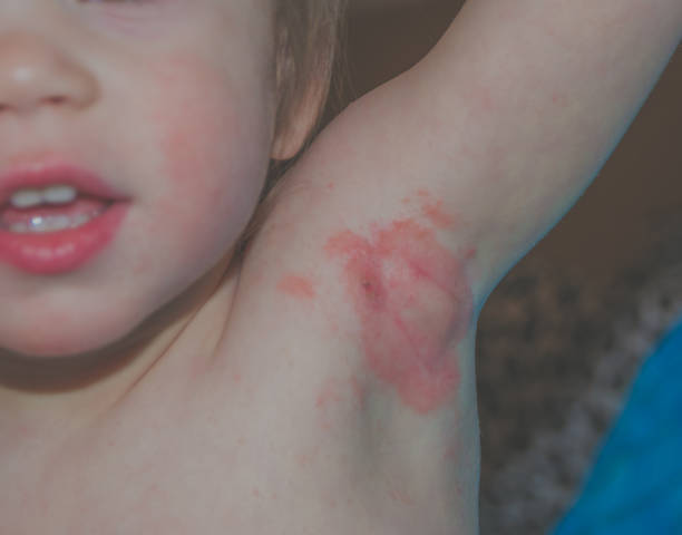 istock the child in the armpit inflammation 872433032