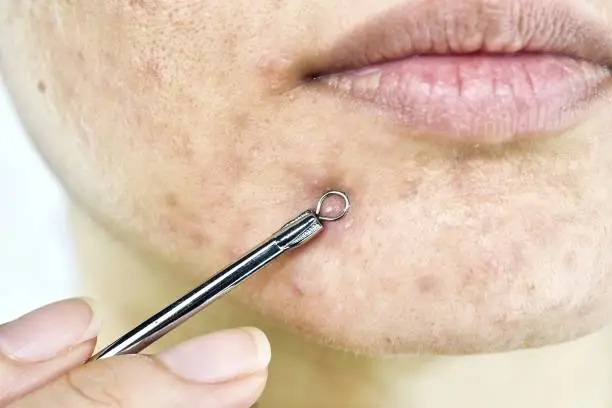 Photo of Skin problem with acne diseases, Close up woman face squeezing whitehead pimples on chin with acne removal tool, Scar and oily greasy face, Beauty concept.
