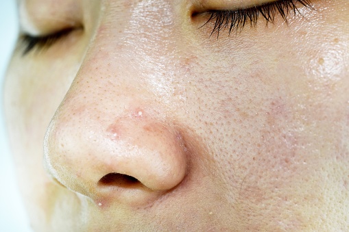 Problema de la piel con acné enfermedades, Close up de cara de mujer con espinillas de whitehead en nariz, cicatriz y cara grasienta aceitosa, concepto de belleza. photo