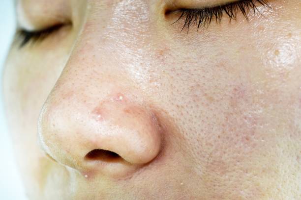 Skin problem with acne diseases, Close up woman face with whitehead pimples on nose, Scar and oily greasy face, Beauty concept. Skin problem with acne diseases, Close up woman face with whitehead pimples on nose, Scar and oily greasy face, Beauty concept. estrogen photos stock pictures, royalty-free photos & images