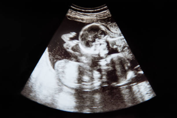 Baby Ultrasound Identical Twins Baby Ultrasound of Identical Twins laying upside down twin stock pictures, royalty-free photos & images