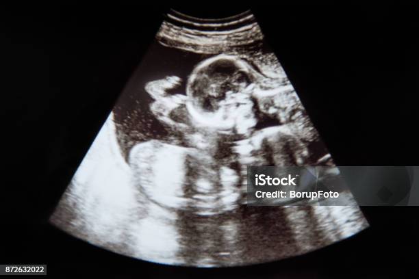 Baby Ultrasound Identical Twins Stock Photo - Download Image Now - Twin, Ultrasound, Fetus