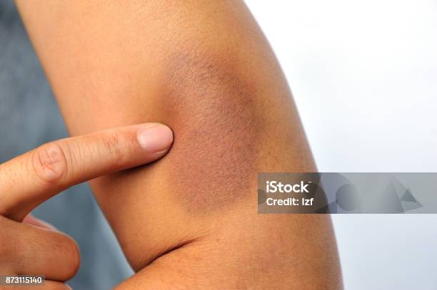 Bruised And Injured From Domestic Violence Stock Photo - Download Image Now - Domestic Violence, Bruise, Abandoned