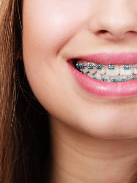istock Woman showing her teeth with braces 873126790