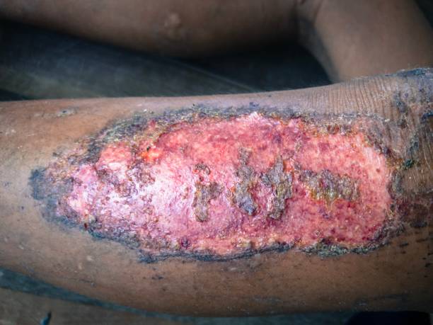 Chronic wounds on leg stock photo