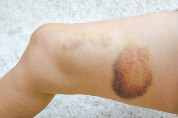 istock Large bruise on human leg. Injection bruises. Doctor and patient 873492268