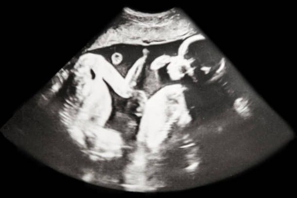 istock Baby Ultrasound Identical Twins 873509220