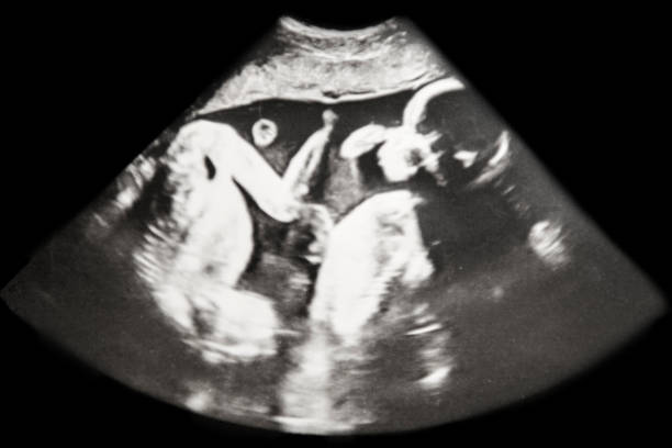 Baby Ultrasound Identical Twins Baby Ultrasound of Identical Twins laying upside down (week 22) medical scan photos stock pictures, royalty-free photos & images