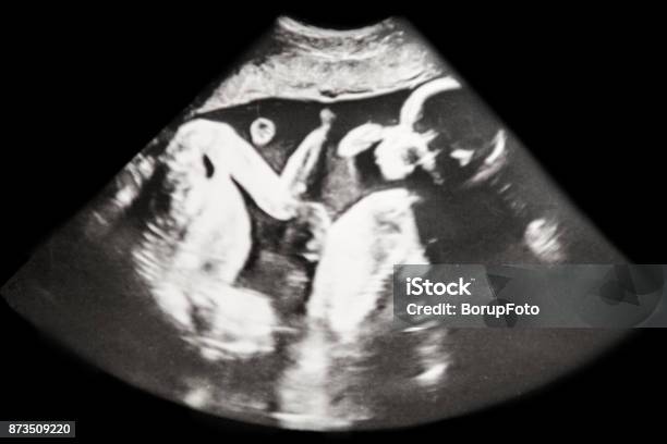 Baby Ultrasound Identical Twins Stock Photo - Download Image Now - Twin, Ultrasound, Pregnant