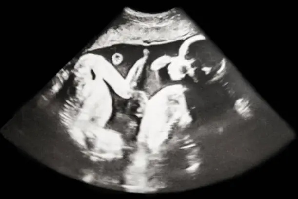 Photo of Baby Ultrasound Identical Twins